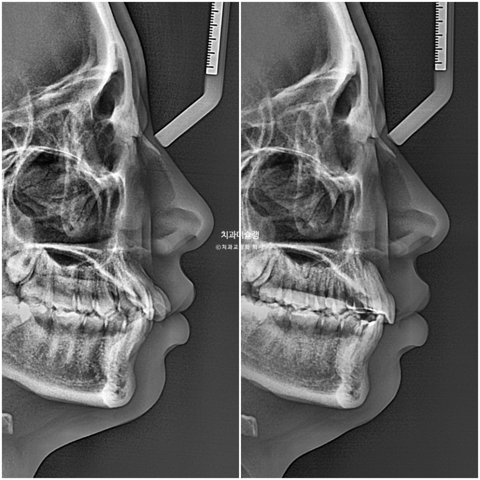 비발치 인비절라인 선천적 결손 3전치 치간삭제 배열위주 교정 치료기간 1년 재제작 1회