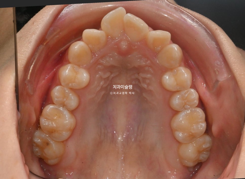 비발치 인비절라인 선천적 결손 3전치 치간삭제 배열위주 교정 치료기간 1년 재제작 1회