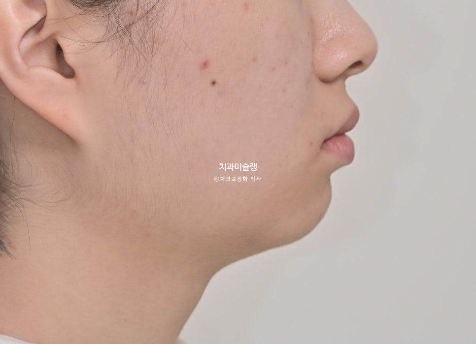 비발치 인비절라인 선천적 결손 3전치 치간삭제 배열위주 교정 치료기간 1년 재제작 1회