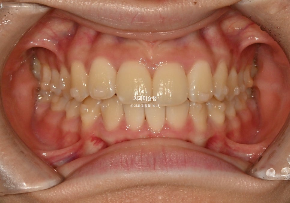 비발치 인비절라인 선천적 결손 3전치 치간삭제 배열위주 교정 치료기간 1년 재제작 1회