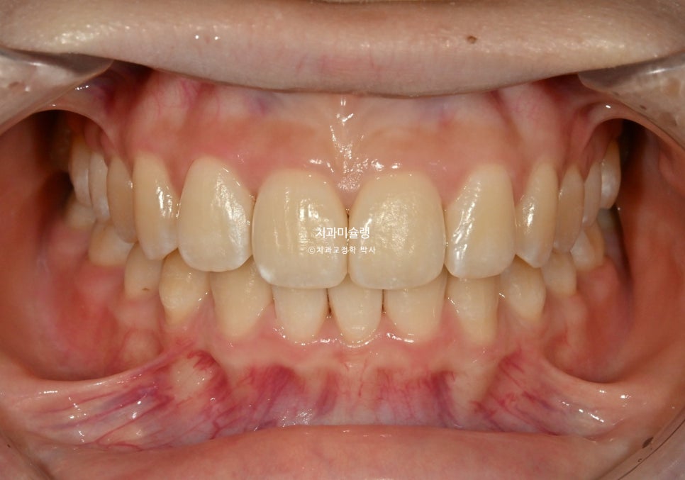 비발치 인비절라인 선천적 결손 3전치 치간삭제 배열위주 교정 치료기간 1년 재제작 1회
