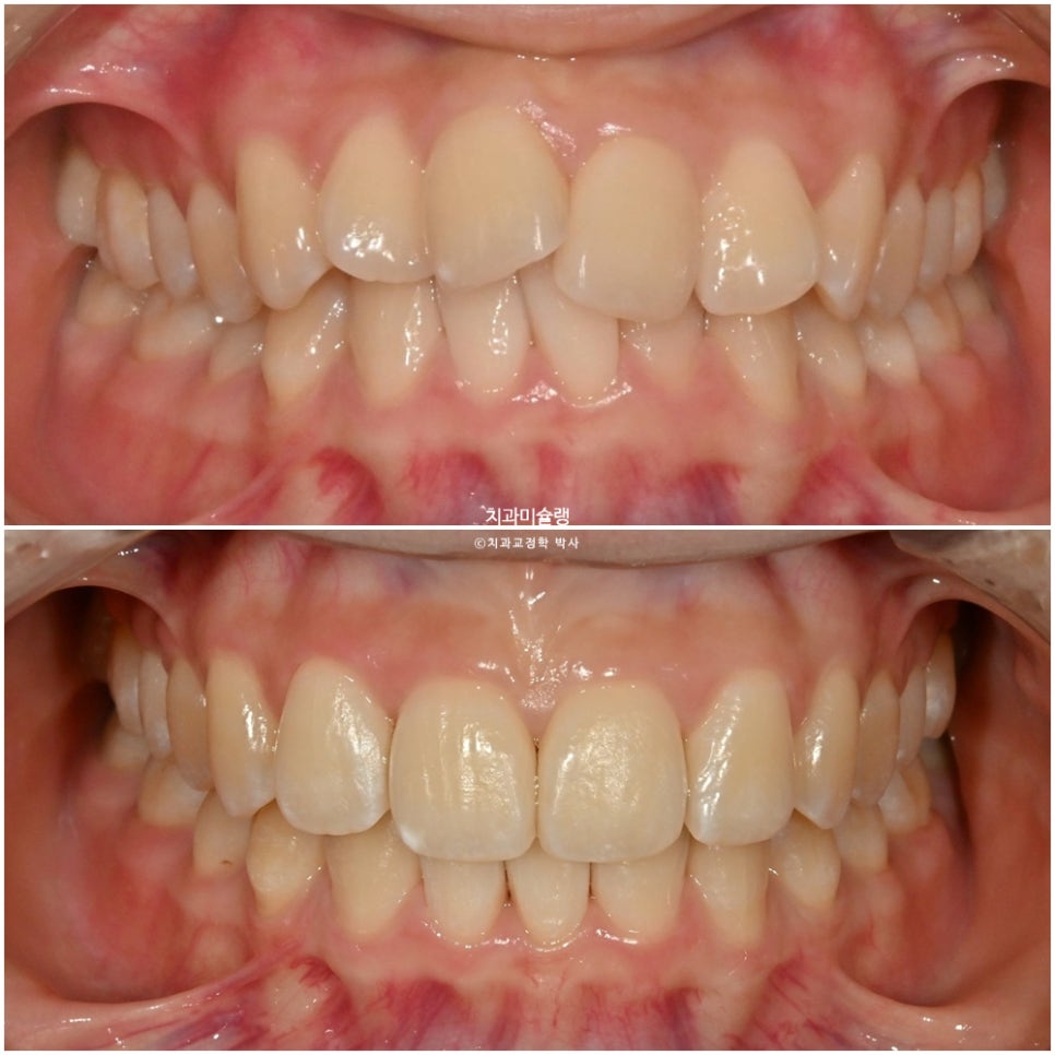 비발치 인비절라인 선천적 결손 3전치 치간삭제 배열위주 교정 치료기간 1년 재제작 1회