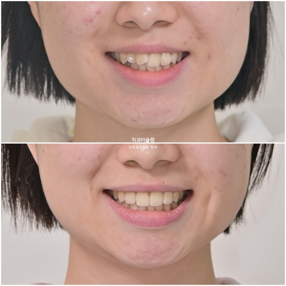 비발치 인비절라인 선천적 결손 3전치 치간삭제 배열위주 교정 치료기간 1년 재제작 1회