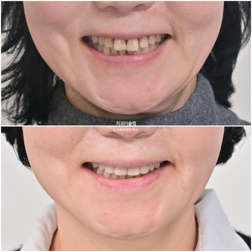 60대 인비절라인 익스프레스 벌어진 틈 치주 노년 교정 블랙트라이앵글 레진 수복 치료기간 11개월 재제작 1회