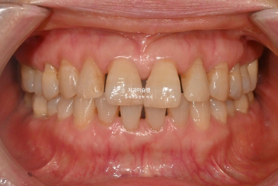 60대 인비절라인 익스프레스 벌어진 틈 치주 노년 교정 블랙트라이앵글 레진 수복 치료기간 11개월 재제작 1회