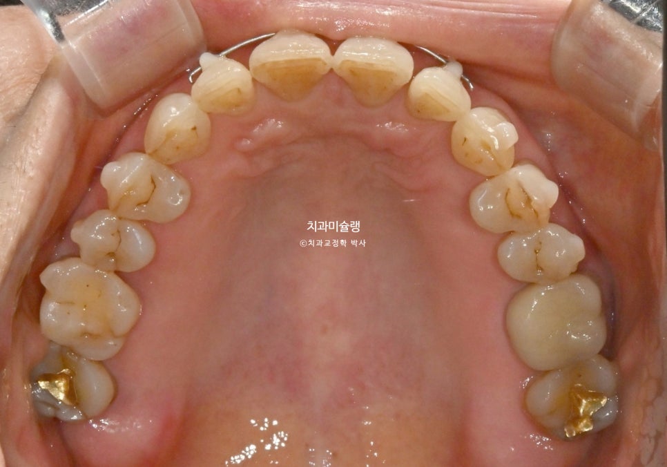 60대 인비절라인 익스프레스 벌어진 틈 치주 노년 교정 블랙트라이앵글 레진 수복 치료기간 11개월 재제작 1회