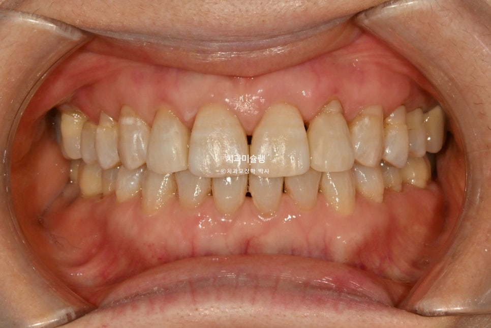 60대 인비절라인 익스프레스 벌어진 틈 치주 노년 교정 블랙트라이앵글 레진 수복 치료기간 11개월 재제작 1회