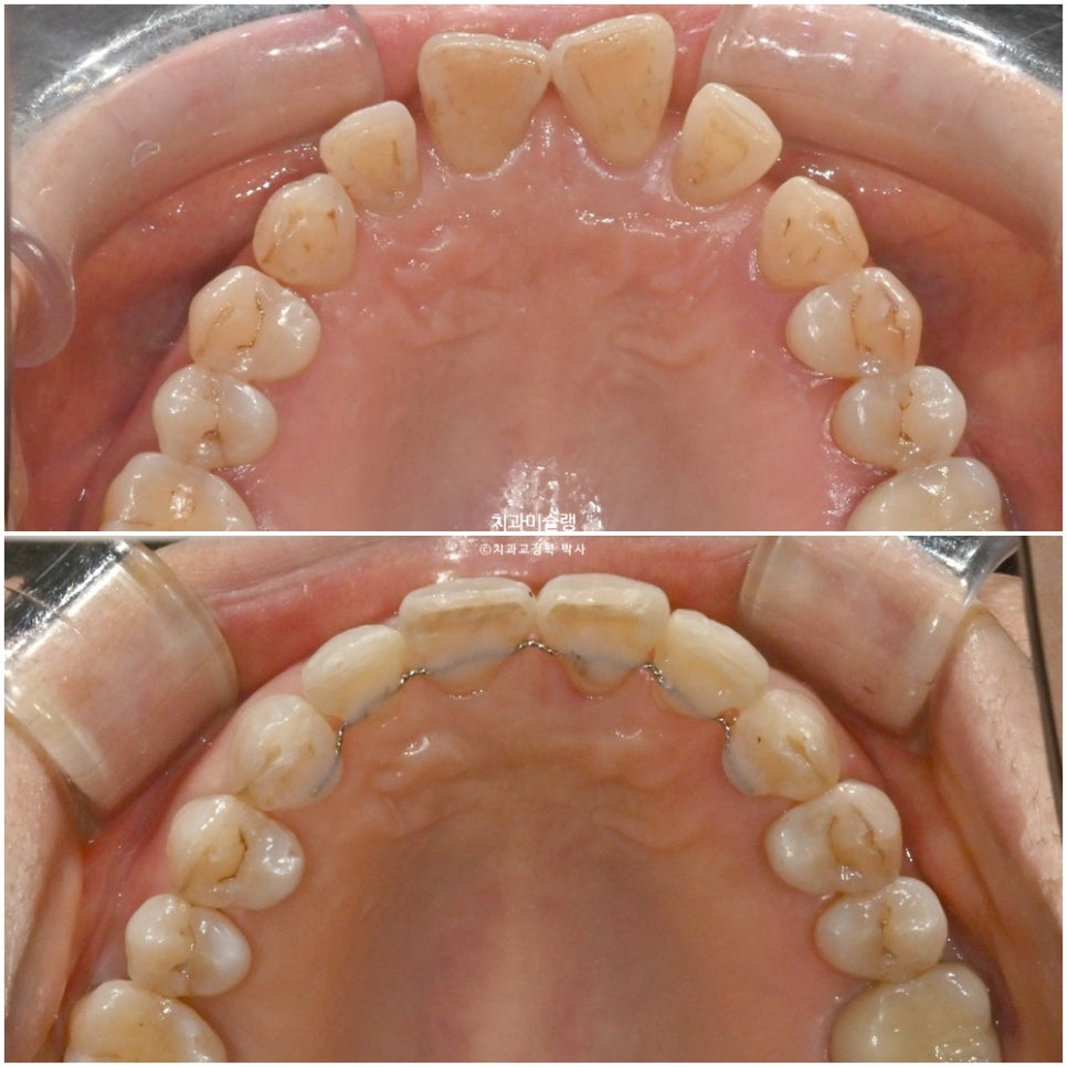 60대 인비절라인 익스프레스 벌어진 틈 치주 노년 교정 블랙트라이앵글 레진 수복 치료기간 11개월 재제작 1회