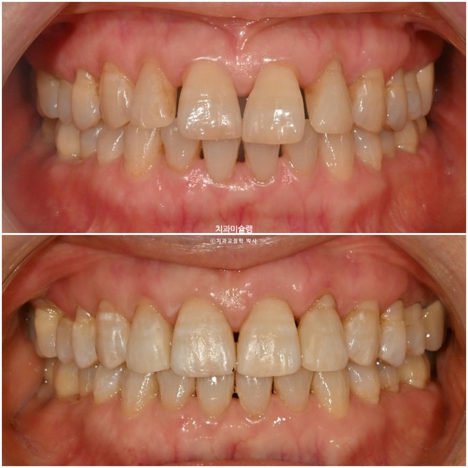 60대 인비절라인 익스프레스 벌어진 틈 치주 노년 교정 블랙트라이앵글 레진 수복 치료기간 11개월 재제작 1회