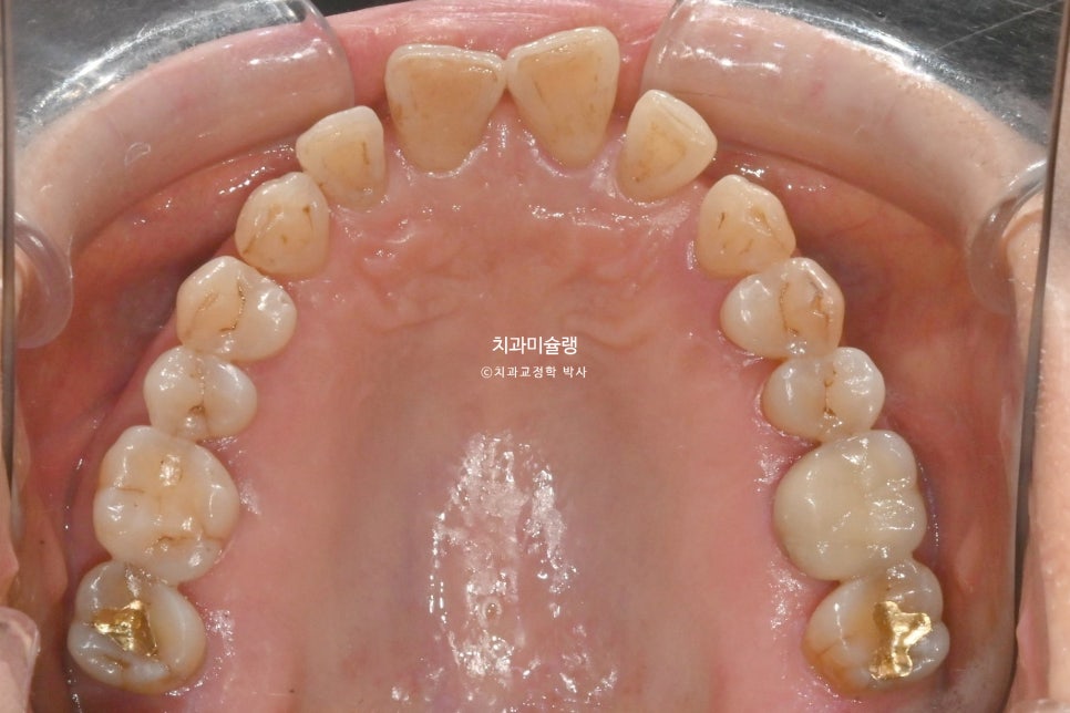 60대 인비절라인 익스프레스 벌어진 틈 치주 노년 교정 블랙트라이앵글 레진 수복 치료기간 11개월 재제작 1회