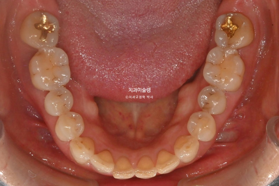 60대 인비절라인 익스프레스 벌어진 틈 치주 노년 교정 블랙트라이앵글 레진 수복 치료기간 11개월 재제작 1회