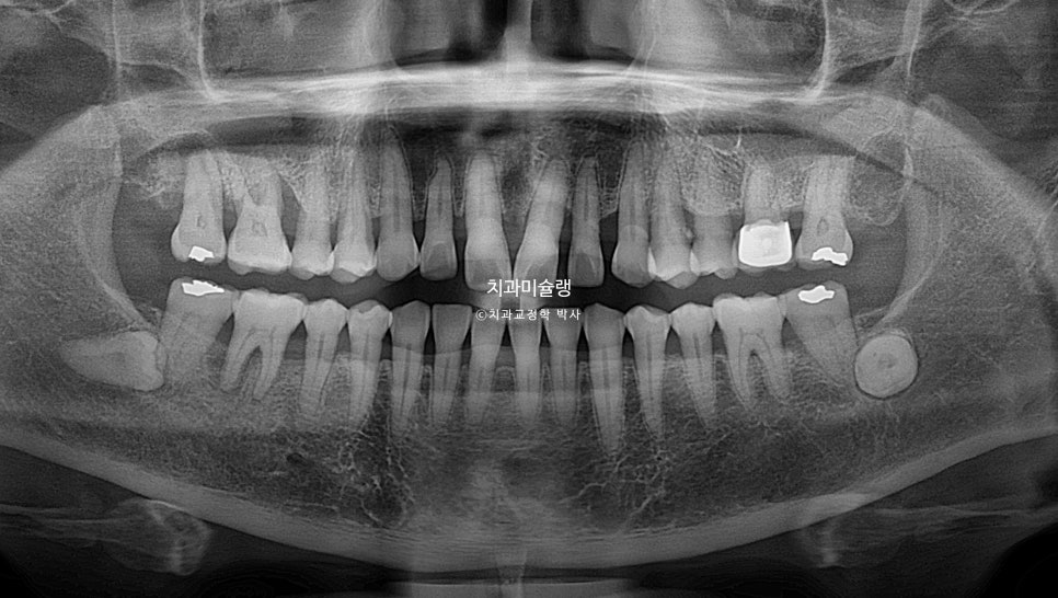 60대 인비절라인 익스프레스 벌어진 틈 치주 노년 교정 블랙트라이앵글 레진 수복 치료기간 11개월 재제작 1회
