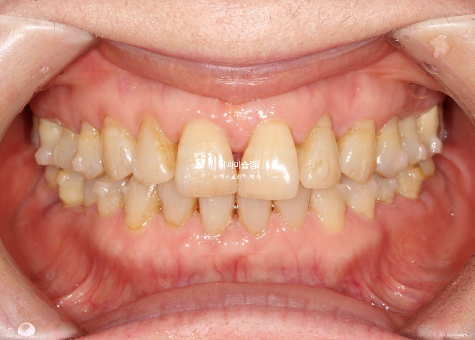 60대 인비절라인 익스프레스 벌어진 틈 치주 노년 교정 블랙트라이앵글 레진 수복 치료기간 11개월 재제작 1회