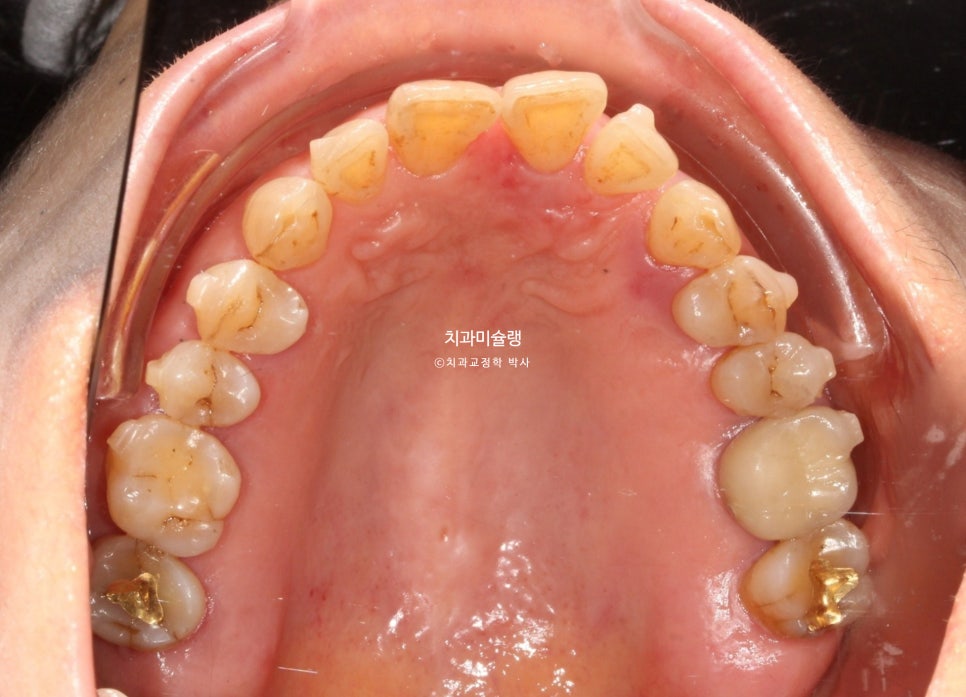 60대 인비절라인 익스프레스 벌어진 틈 치주 노년 교정 블랙트라이앵글 레진 수복 치료기간 11개월 재제작 1회