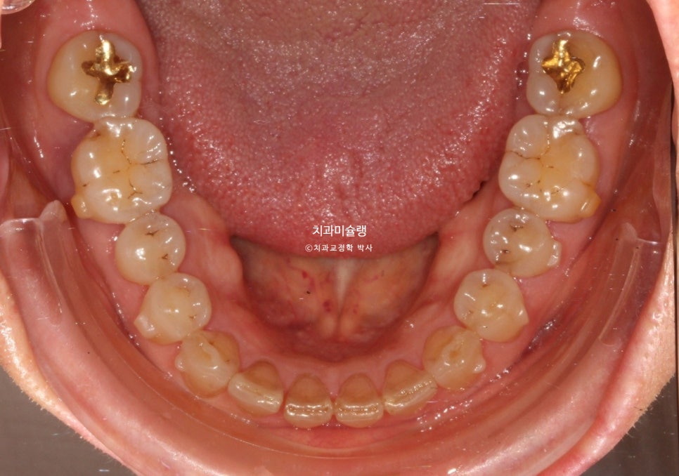 60대 인비절라인 익스프레스 벌어진 틈 치주 노년 교정 블랙트라이앵글 레진 수복 치료기간 11개월 재제작 1회