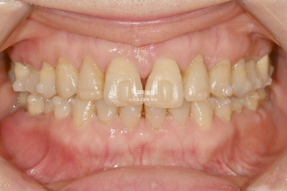 60대 인비절라인 익스프레스 벌어진 틈 치주 노년 교정 블랙트라이앵글 레진 수복 치료기간 11개월 재제작 1회