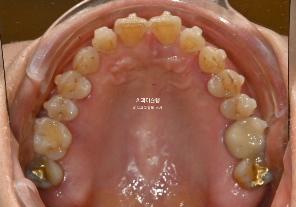 60대 인비절라인 익스프레스 벌어진 틈 치주 노년 교정 블랙트라이앵글 레진 수복 치료기간 11개월 재제작 1회