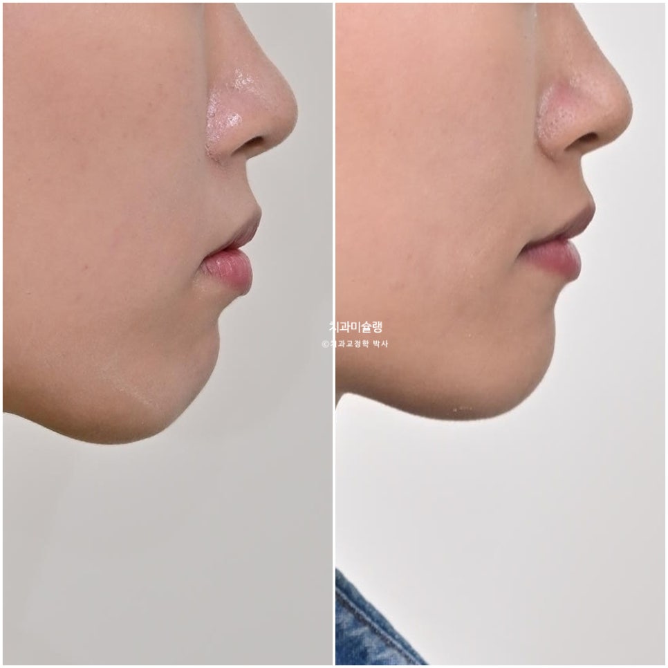 하관이 짧아지는 비발치 돌출입 교정 상악 전체 함입 하악골 자가회전 유도 교정 치료기간 1년 3개월