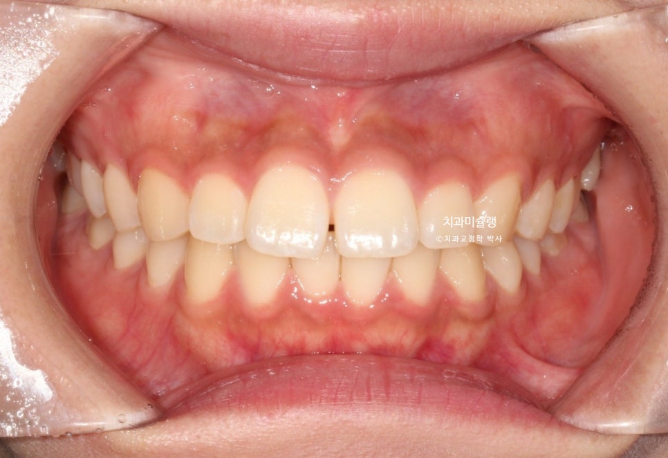 하관이 짧아지는 비발치 돌출입 교정 상악 전체 함입 하악골 자가회전 유도 교정 치료기간 1년 3개월