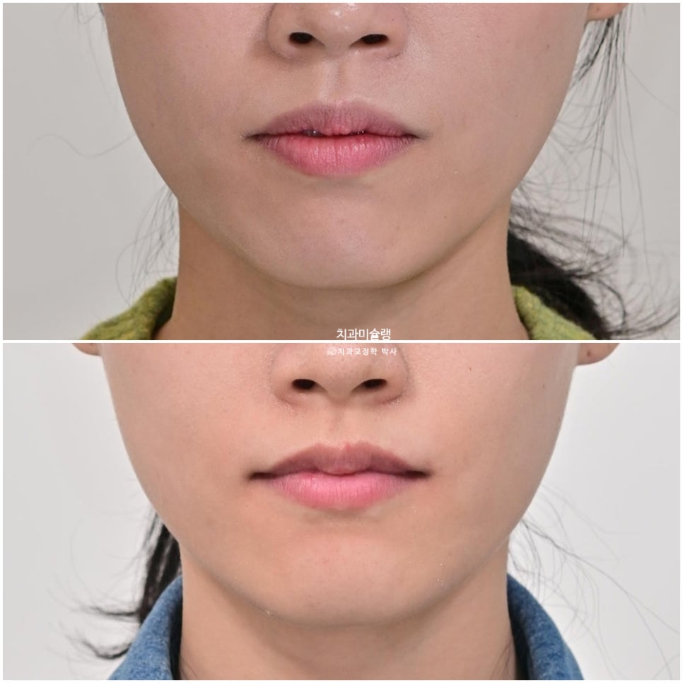 하관이 짧아지는 비발치 돌출입 교정 상악 전체 함입 하악골 자가회전 유도 교정 치료기간 1년 3개월