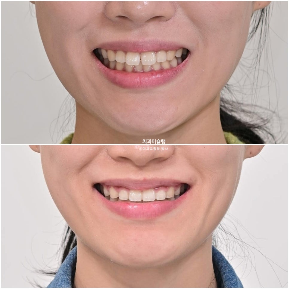 하관이 짧아지는 비발치 돌출입 교정 상악 전체 함입 하악골 자가회전 유도 교정 치료기간 1년 3개월