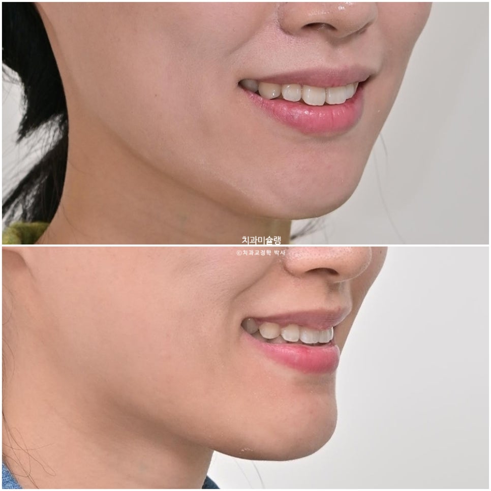 하관이 짧아지는 비발치 돌출입 교정 상악 전체 함입 하악골 자가회전 유도 교정 치료기간 1년 3개월