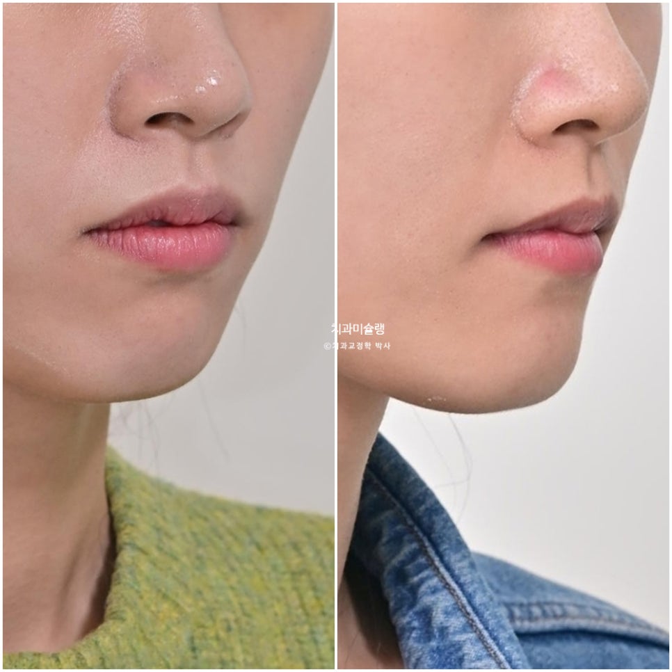 하관이 짧아지는 비발치 돌출입 교정 상악 전체 함입 하악골 자가회전 유도 교정 치료기간 1년 3개월