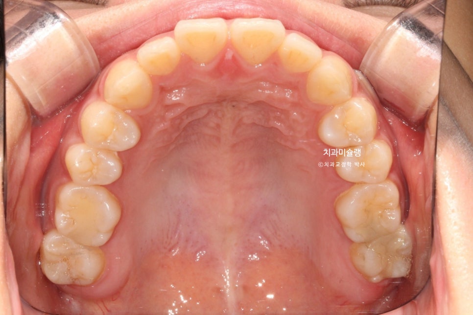 하관이 짧아지는 비발치 돌출입 교정 상악 전체 함입 하악골 자가회전 유도 교정 치료기간 1년 3개월
