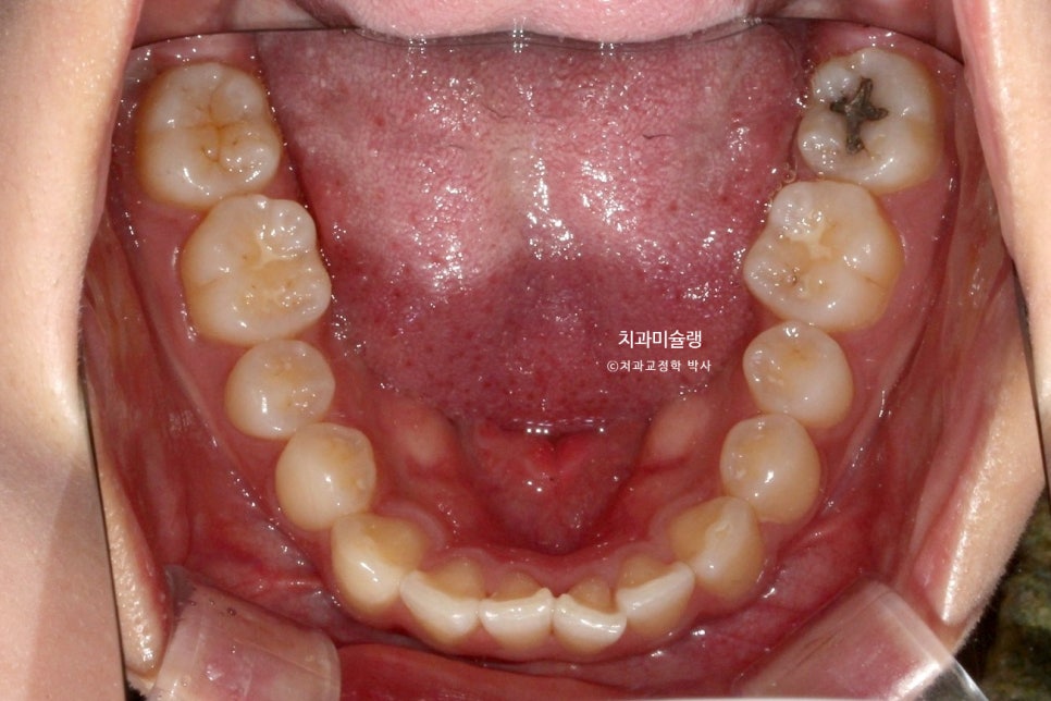 하관이 짧아지는 비발치 돌출입 교정 상악 전체 함입 하악골 자가회전 유도 교정 치료기간 1년 3개월