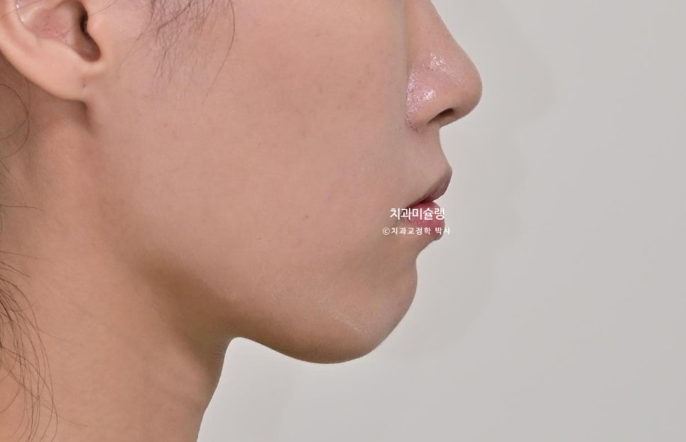 하관이 짧아지는 비발치 돌출입 교정 상악 전체 함입 하악골 자가회전 유도 교정 치료기간 1년 3개월