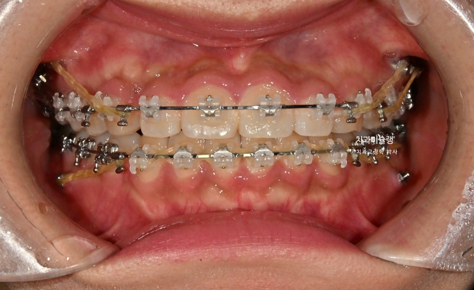 하관이 짧아지는 비발치 돌출입 교정 상악 전체 함입 하악골 자가회전 유도 교정 치료기간 1년 3개월