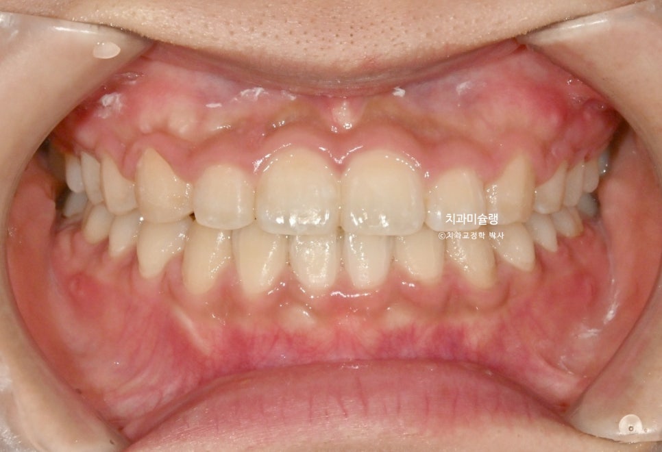 하관이 짧아지는 비발치 돌출입 교정 상악 전체 함입 하악골 자가회전 유도 교정 치료기간 1년 3개월