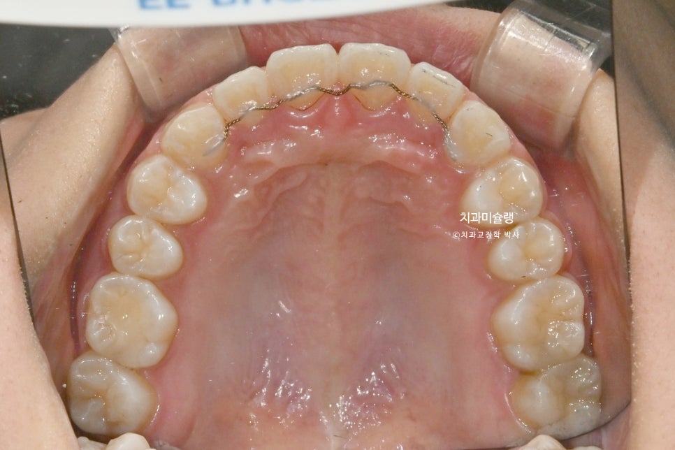 하관이 짧아지는 비발치 돌출입 교정 상악 전체 함입 하악골 자가회전 유도 교정 치료기간 1년 3개월