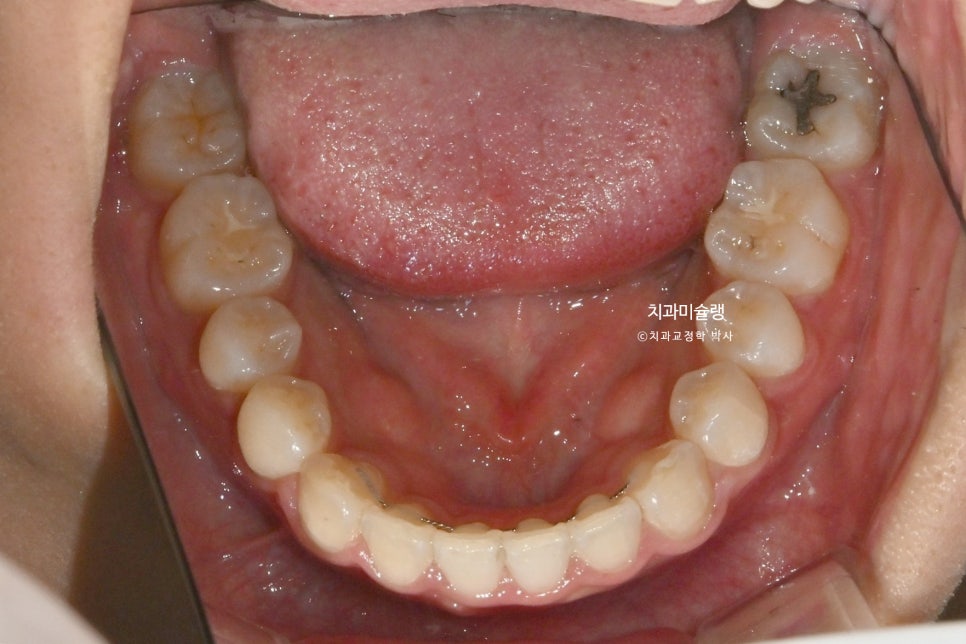 하관이 짧아지는 비발치 돌출입 교정 상악 전체 함입 하악골 자가회전 유도 교정 치료기간 1년 3개월
