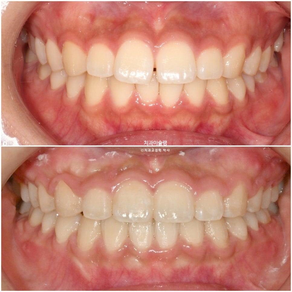 하관이 짧아지는 비발치 돌출입 교정 상악 전체 함입 하악골 자가회전 유도 교정 치료기간 1년 3개월