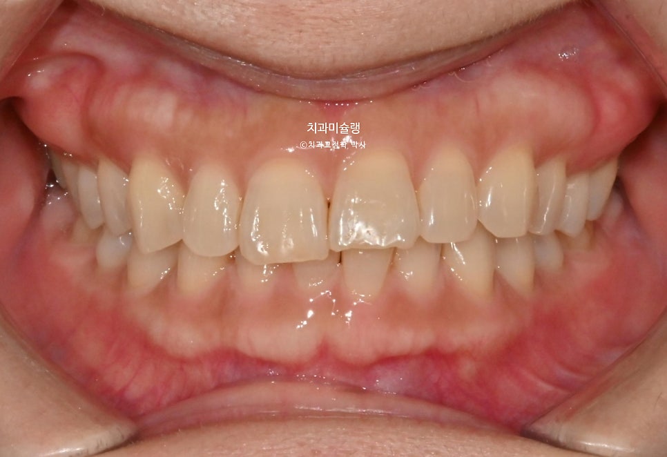 40대 스마일라인 캔팅 과개교합 인비절라인 라이트 치료기간 7개월 재제작 1회