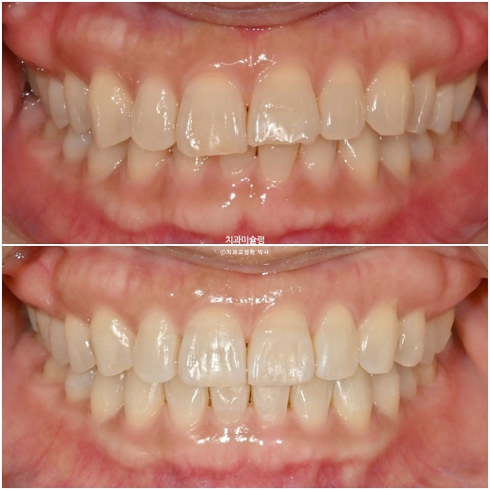 40대 스마일라인 캔팅 과개교합 인비절라인 라이트 치료기간 7개월 재제작 1회