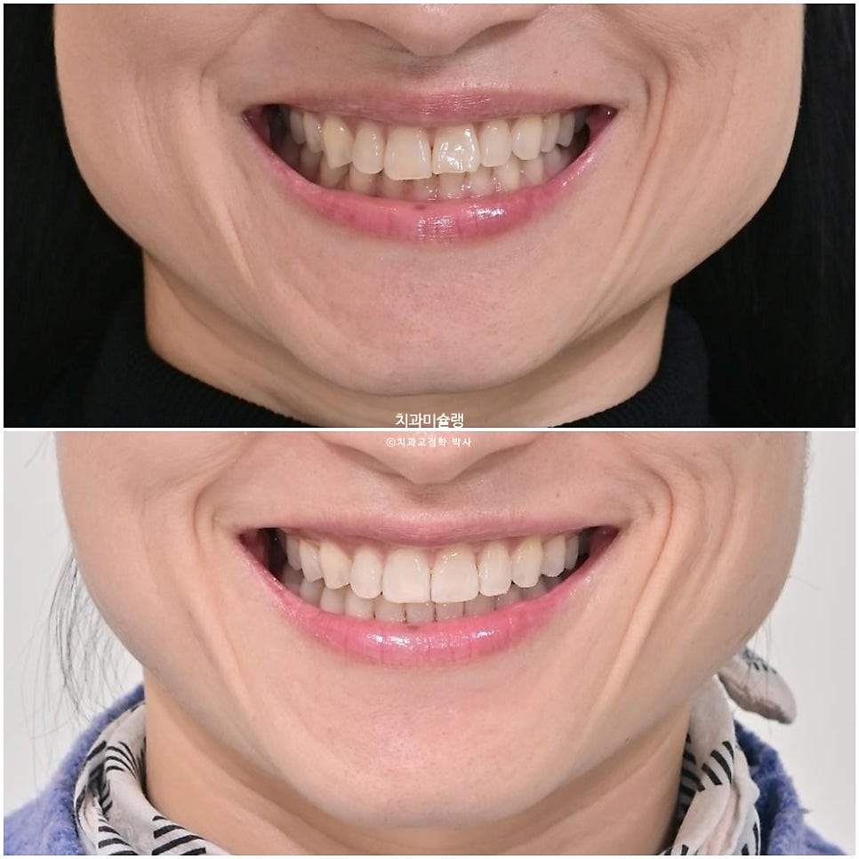 40대 스마일라인 캔팅 과개교합 인비절라인 라이트 치료기간 7개월 재제작 1회