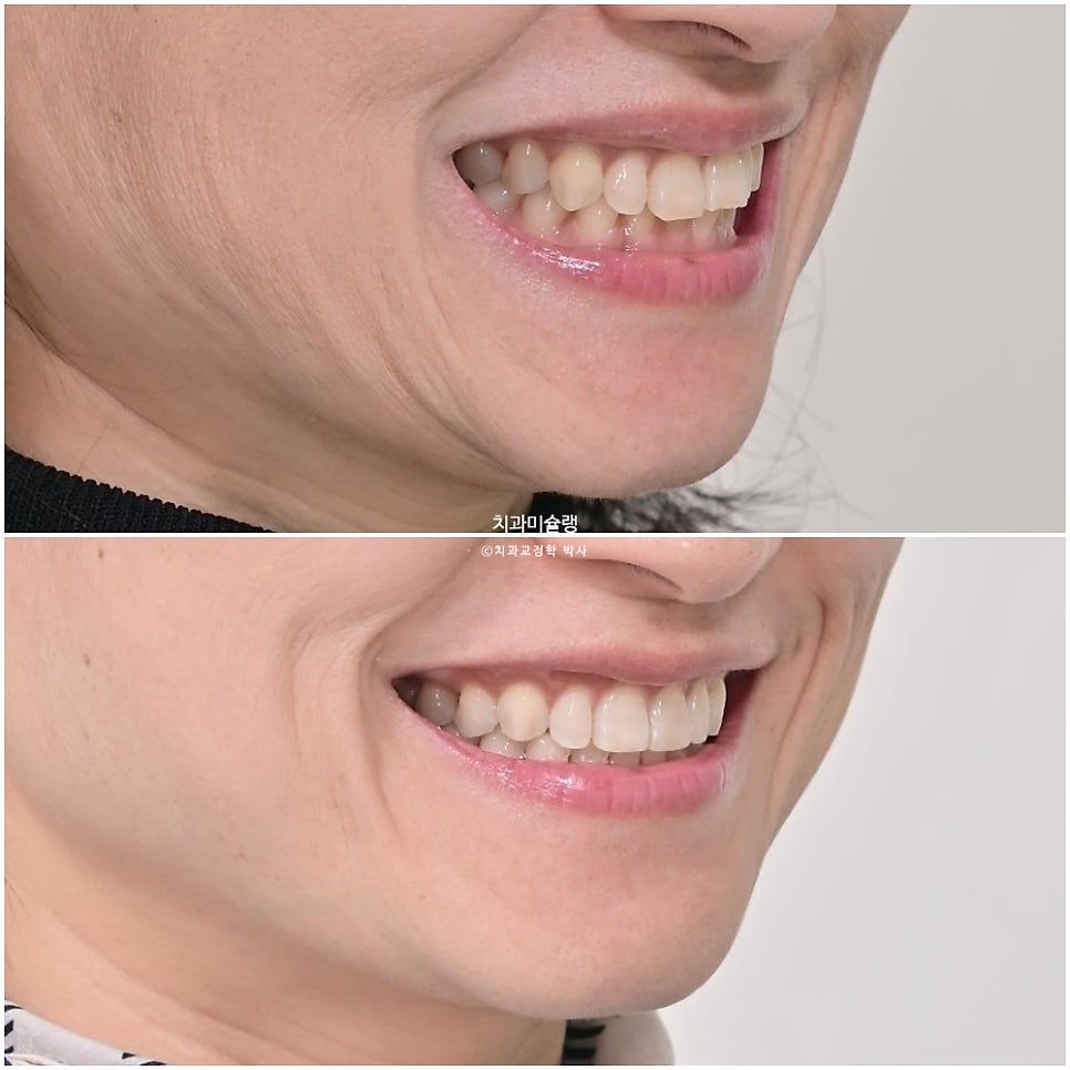 40대 스마일라인 캔팅 과개교합 인비절라인 라이트 치료기간 7개월 재제작 1회