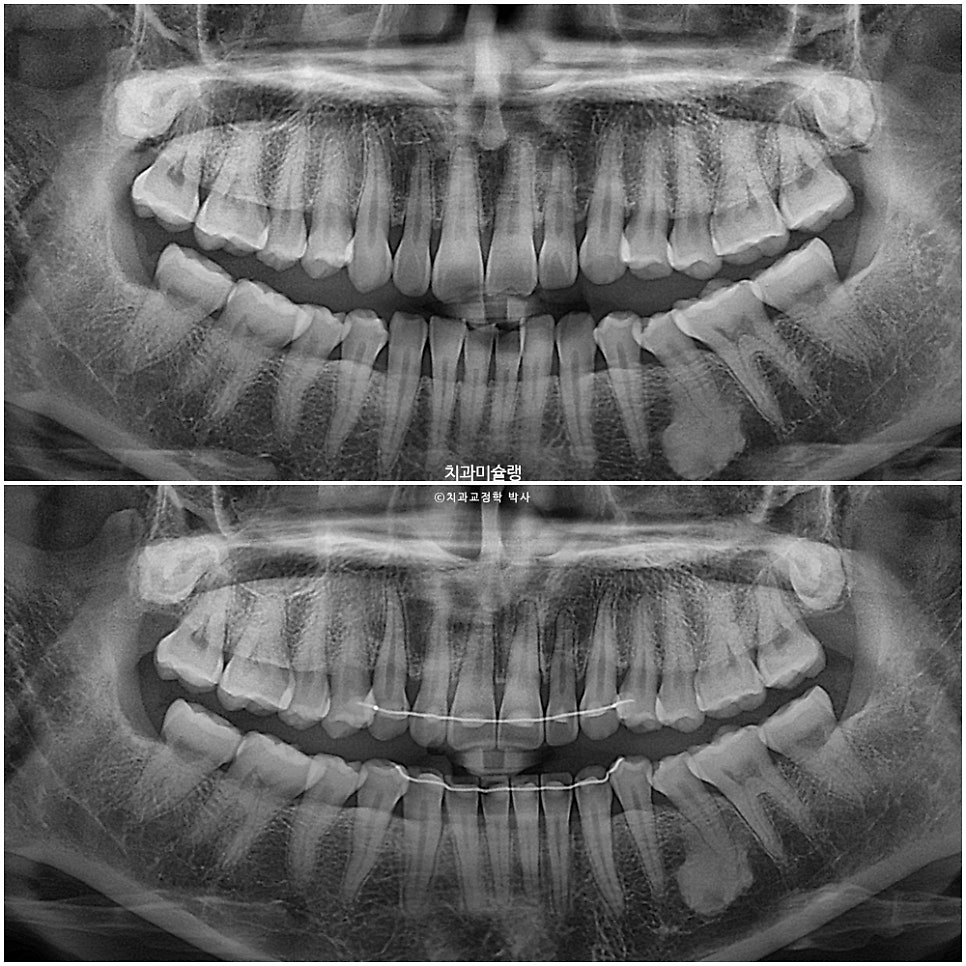 40대 스마일라인 캔팅 과개교합 인비절라인 라이트 치료기간 7개월 재제작 1회