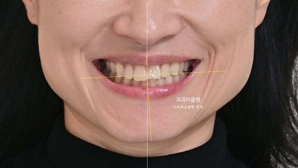 40대 스마일라인 캔팅 과개교합 인비절라인 라이트 치료기간 7개월 재제작 1회