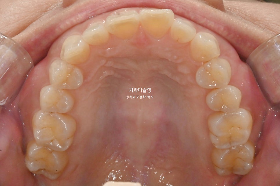 40대 스마일라인 캔팅 과개교합 인비절라인 라이트 치료기간 7개월 재제작 1회