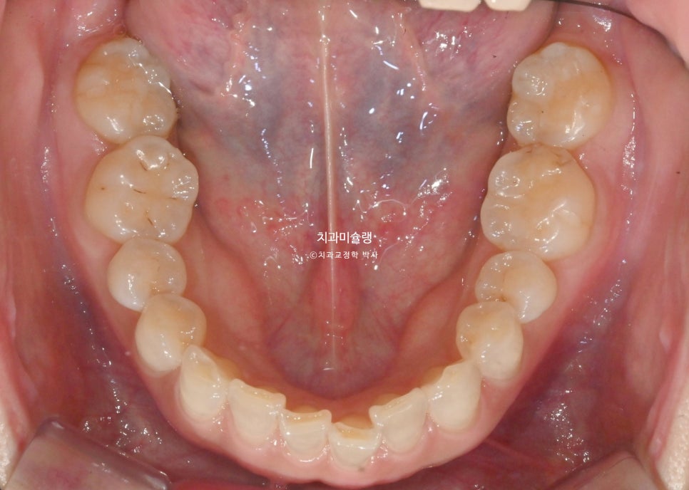40대 스마일라인 캔팅 과개교합 인비절라인 라이트 치료기간 7개월 재제작 1회