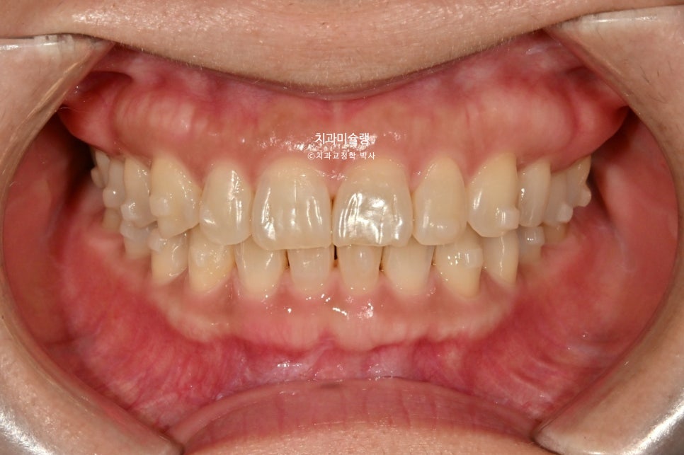 40대 스마일라인 캔팅 과개교합 인비절라인 라이트 치료기간 7개월 재제작 1회