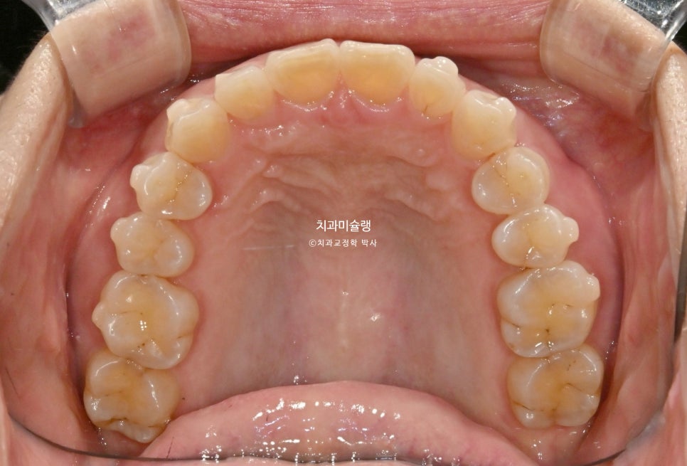 40대 스마일라인 캔팅 과개교합 인비절라인 라이트 치료기간 7개월 재제작 1회