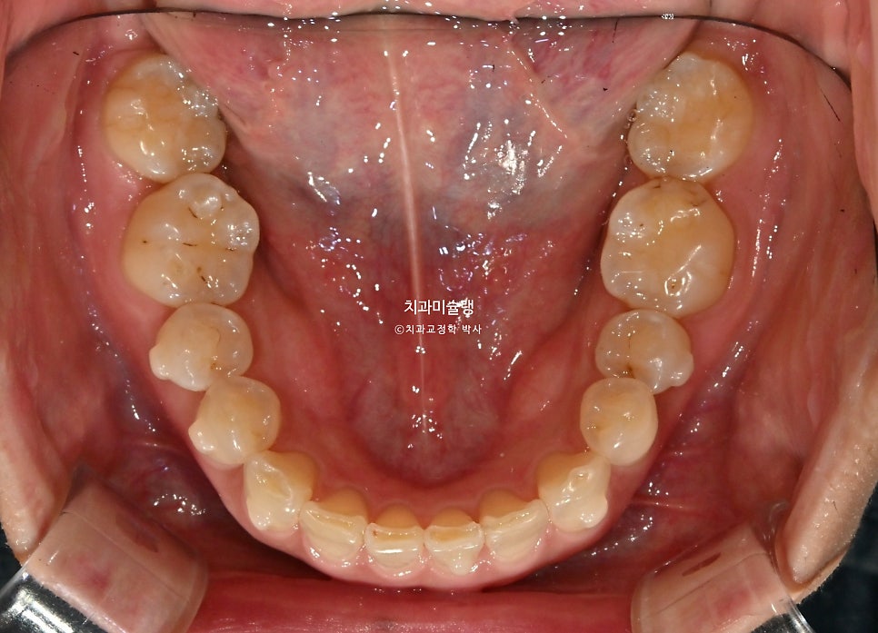 40대 스마일라인 캔팅 과개교합 인비절라인 라이트 치료기간 7개월 재제작 1회