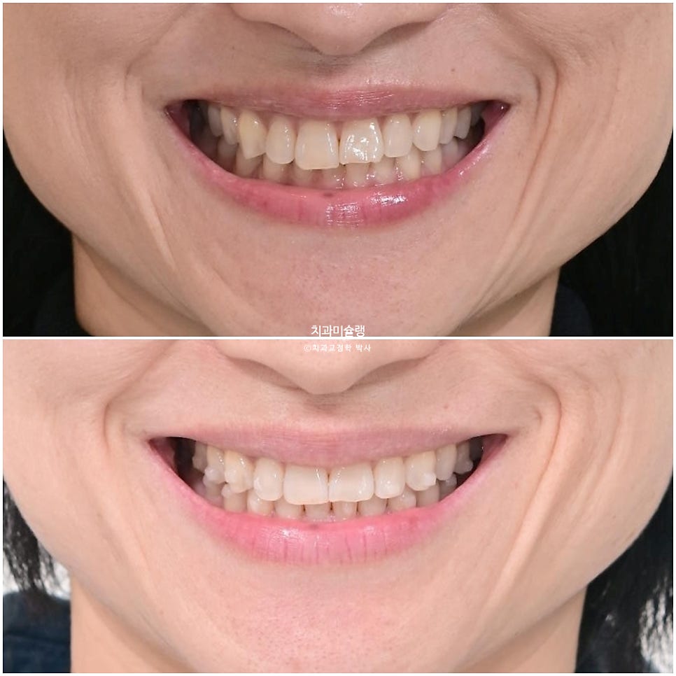 40대 스마일라인 캔팅 과개교합 인비절라인 라이트 치료기간 7개월 재제작 1회