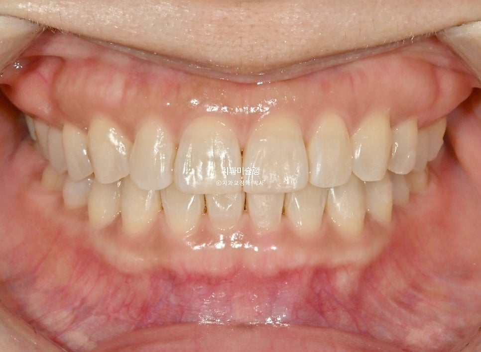 40대 스마일라인 캔팅 과개교합 인비절라인 라이트 치료기간 7개월 재제작 1회