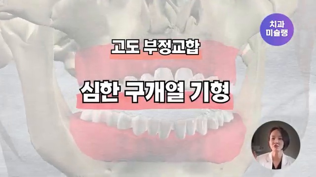 () 부정교합으로 보험적용 군 면제까지? | 오해와 루머 팩트체크 해드립니다