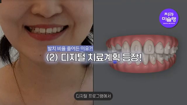 발치 교정, 비발치 교정보다 건강에 안 좋을까? (발치교정 안 하고 싶으시면 필수시청💡🚨)